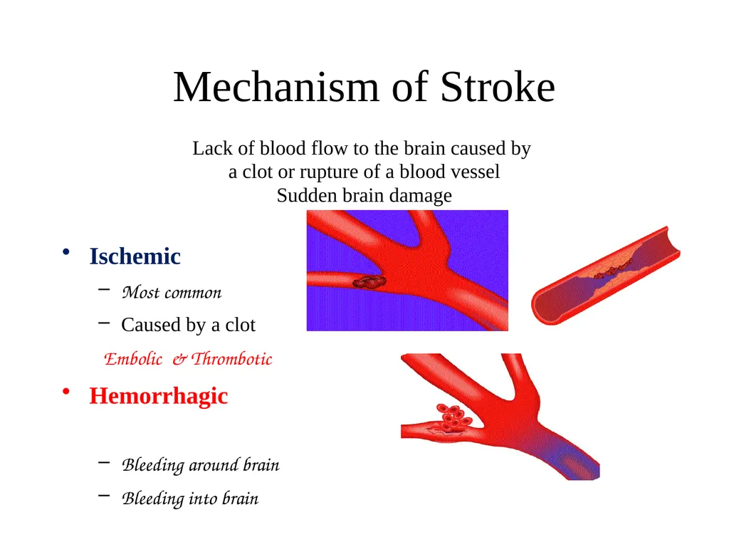 STROKE Dr Muhammah Ashraf Assistant Professor - slide 8 of 15