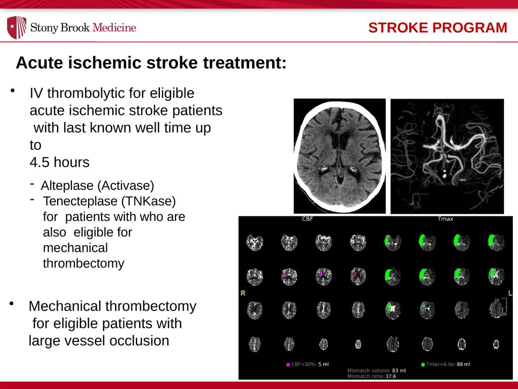 Stony Brook Medicine Comprehensive Stroke Program - slide 9 of 22