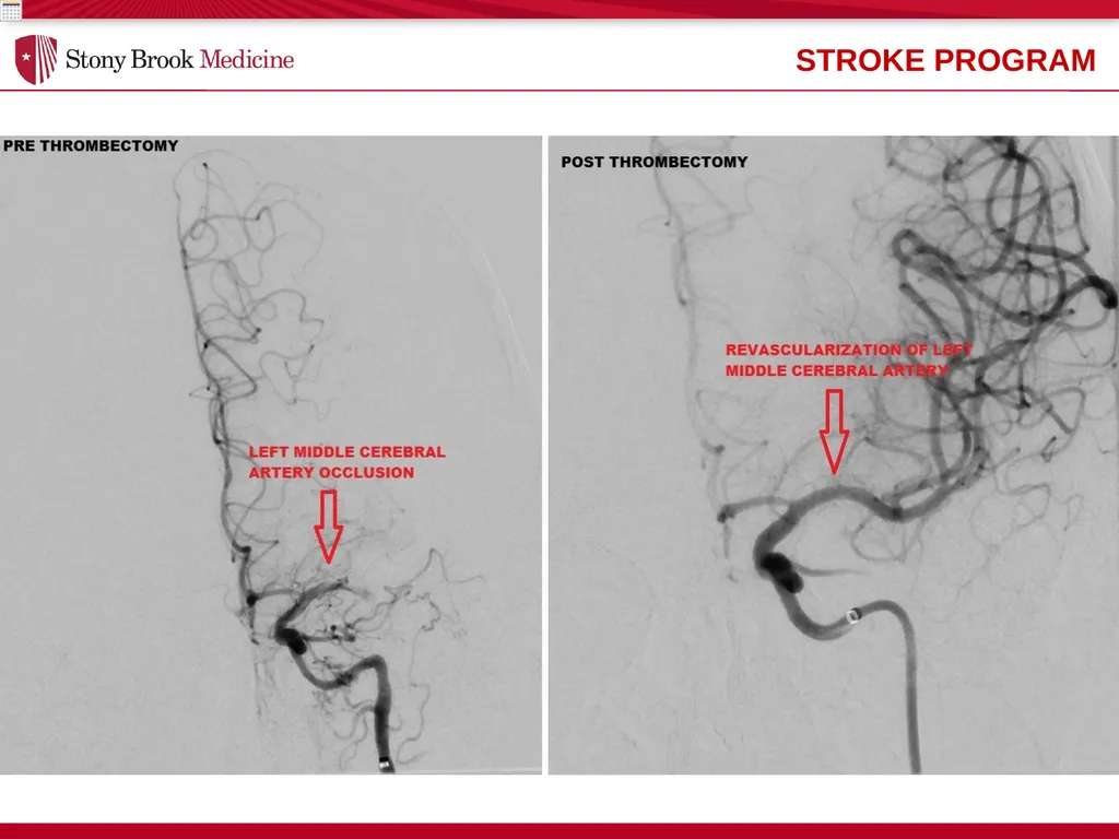 Stony Brook Medicine Comprehensive Stroke Program - slide 10 of 22