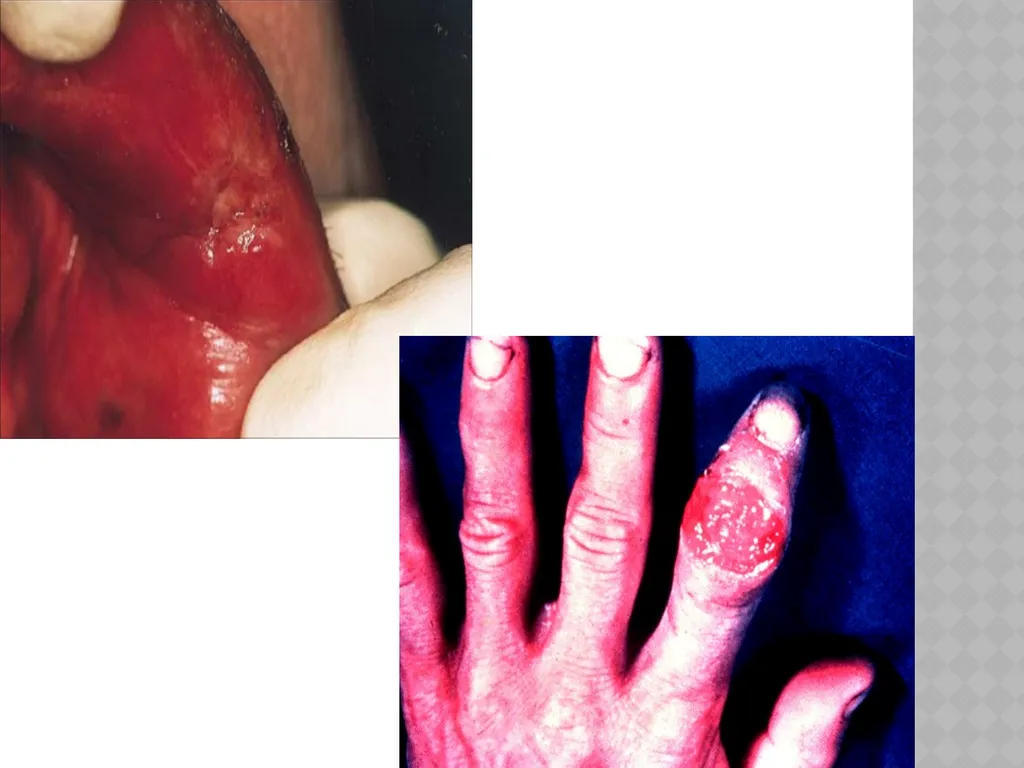 syphilis Learning points INTRODUCTION ETIOLOGY - slide 18 of 75