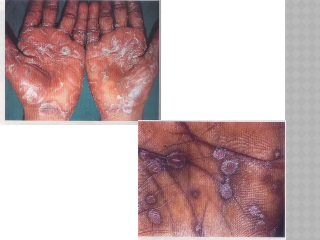 syphilis Learning points INTRODUCTION ETIOLOGY - slide 25 of 75