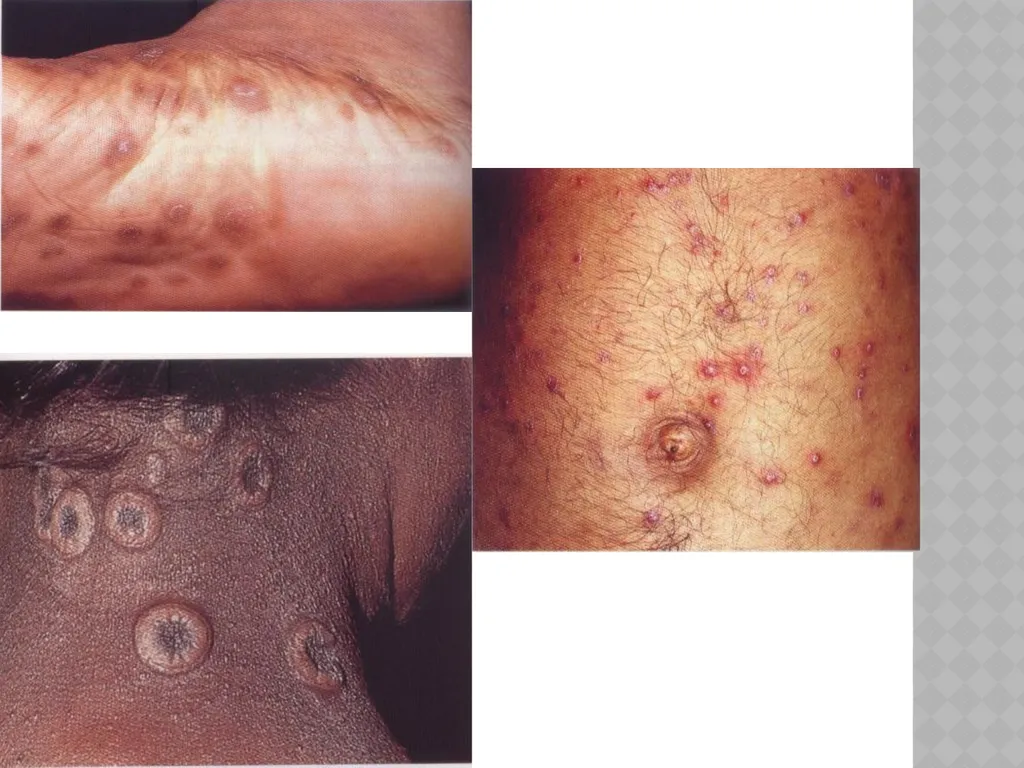 syphilis Learning points INTRODUCTION ETIOLOGY - slide 26 of 75