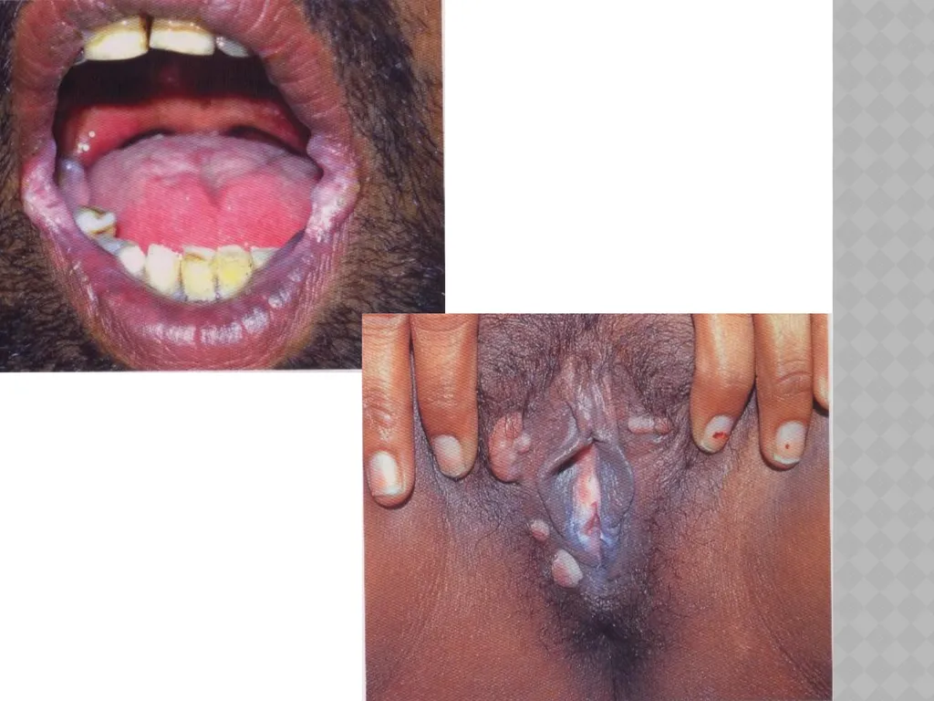 syphilis Learning points INTRODUCTION ETIOLOGY - slide 28 of 75