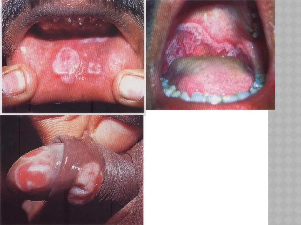 syphilis Learning points INTRODUCTION ETIOLOGY - slide 30 of 75
