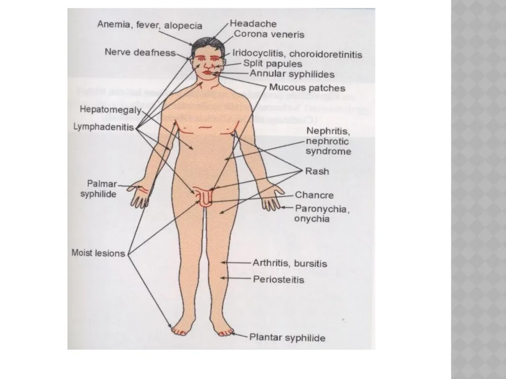 syphilis Learning points INTRODUCTION ETIOLOGY - slide 32 of 75