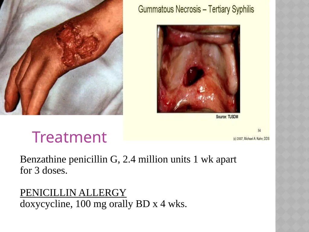 syphilis Learning points INTRODUCTION ETIOLOGY - slide 39 of 75
