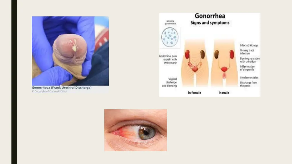 STDS SYPHILIS a bacterial infection usually spread - slide 16 of 25
