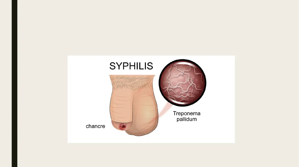 STDS SYPHILIS a bacterial infection usually spread - slide 2 of 25