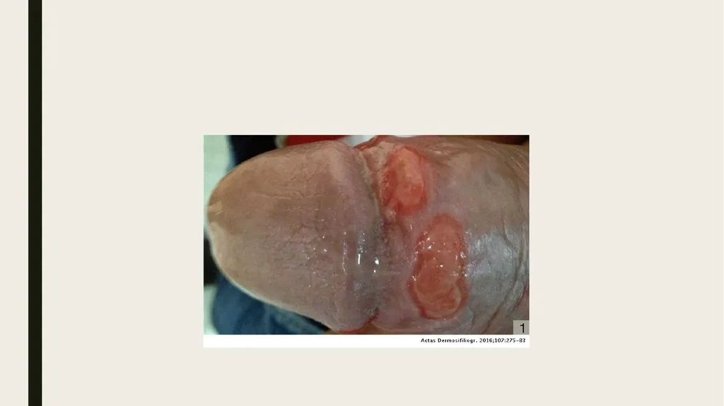 STDS SYPHILIS a bacterial infection usually spread - slide 4 of 25