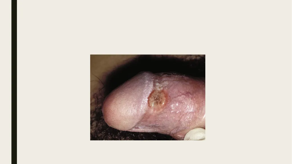 STDS SYPHILIS a bacterial infection usually spread - slide 5 of 25