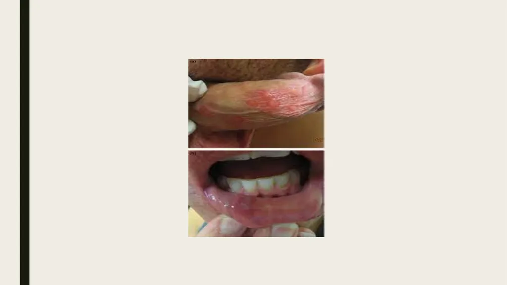 STDS SYPHILIS a bacterial infection usually spread - slide 6 of 25