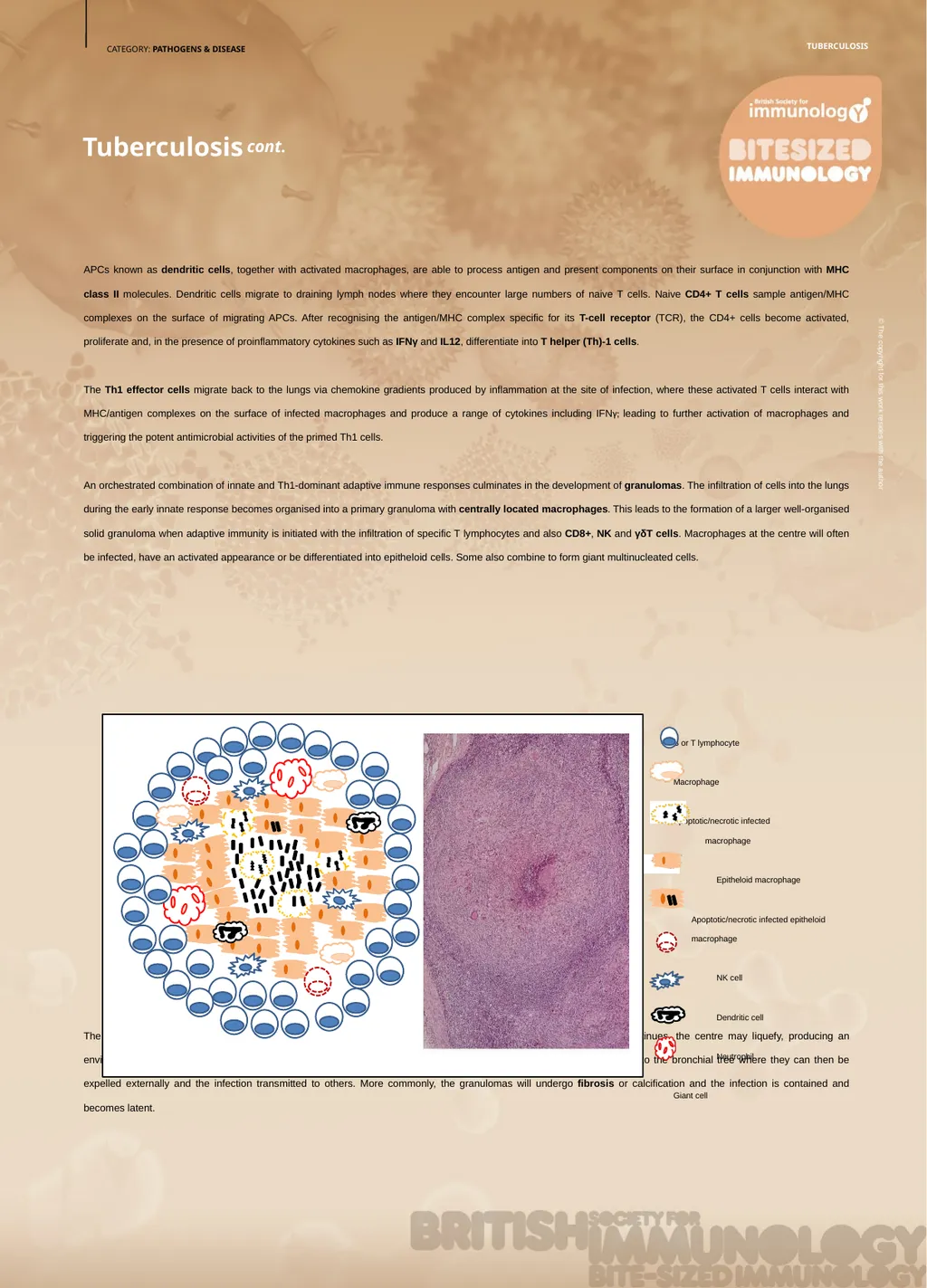 CATEGORY: PATHOGENS & DISEASE Tuberculosis Alice - slide 2 of 2