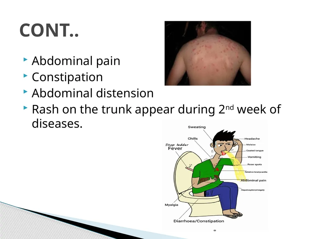 TYPHOID FEVER Typhoid fever is one of a health - slide 10 of 14