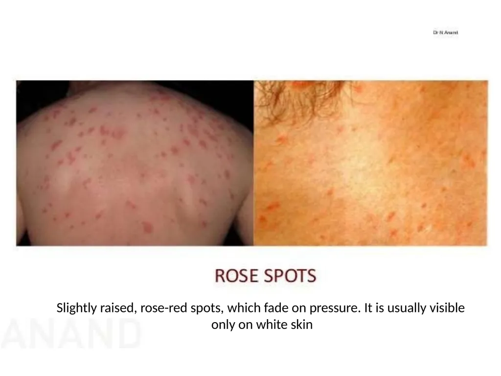 INTRODUCTION Enteric fever, also known as typhoid - slide 10 of 18