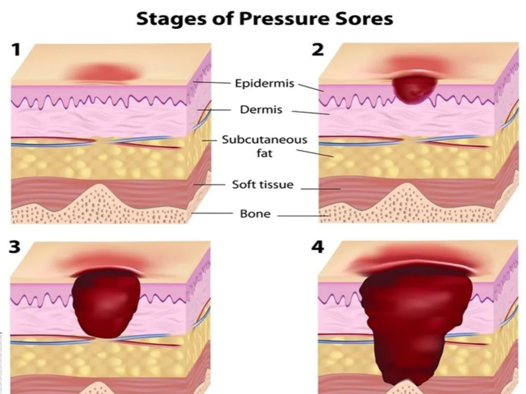 PRESSURE ULCER/BED SORE/DECUBITUS ULCER MS.DEBBY - slide 15 of 48