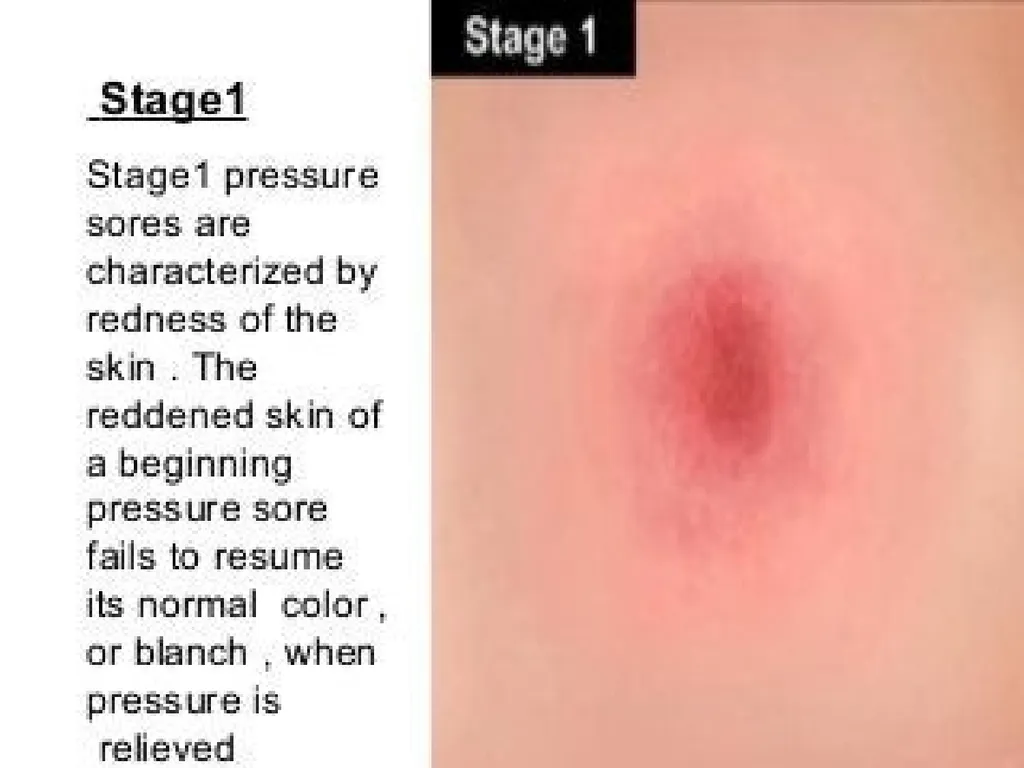 PRESSURE ULCER/BED SORE/DECUBITUS ULCER MS.DEBBY - slide 17 of 48