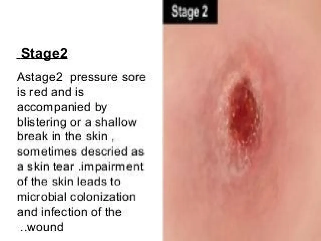 PRESSURE ULCER/BED SORE/DECUBITUS ULCER MS.DEBBY - slide 19 of 48