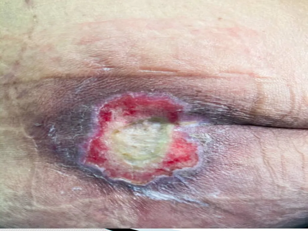 PRESSURE ULCER/BED SORE/DECUBITUS ULCER MS.DEBBY - slide 21 of 48