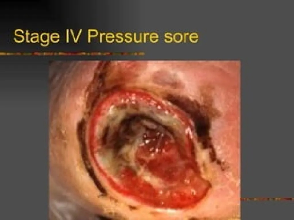 PRESSURE ULCER/BED SORE/DECUBITUS ULCER MS.DEBBY - slide 23 of 48