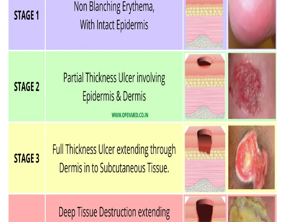 PRESSURE ULCER/BED SORE/DECUBITUS ULCER MS.DEBBY - slide 25 of 48