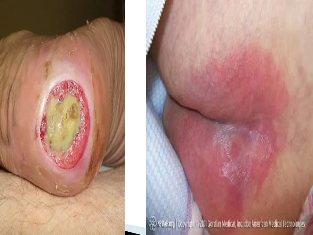 PRESSURE ULCER/BED SORE/DECUBITUS ULCER MS.DEBBY - slide 4 of 48