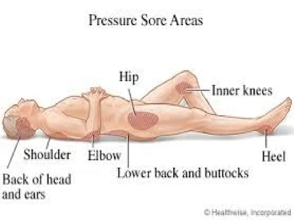 PRESSURE ULCER/BED SORE/DECUBITUS ULCER MS.DEBBY - slide 9 of 48