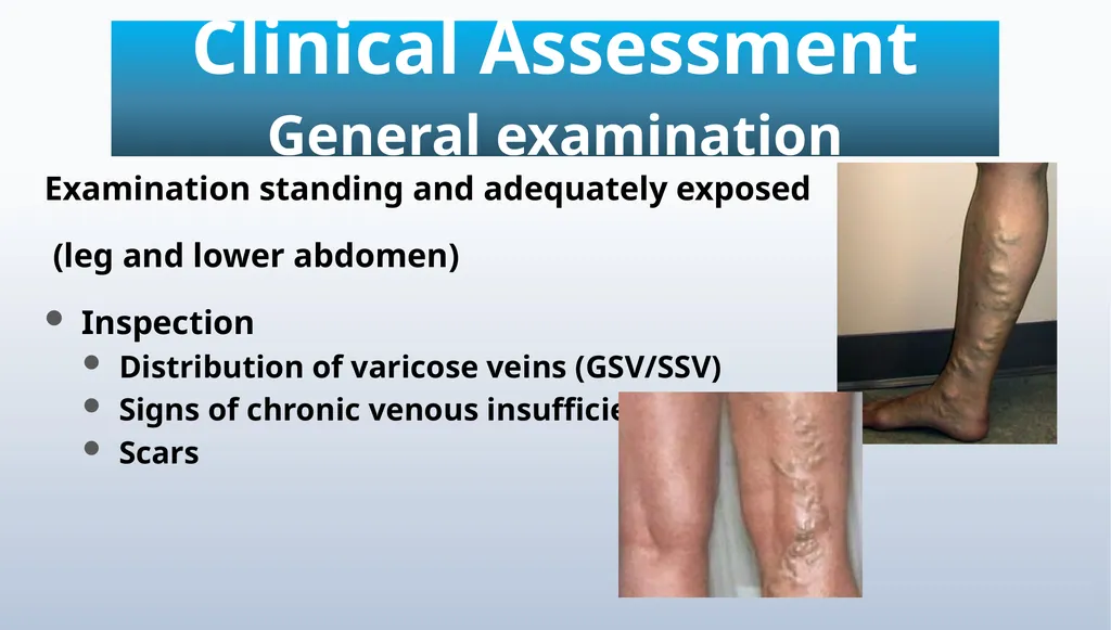 Varicose veins Miss Julie Reid Consultant Vascular - slide 18 of 33