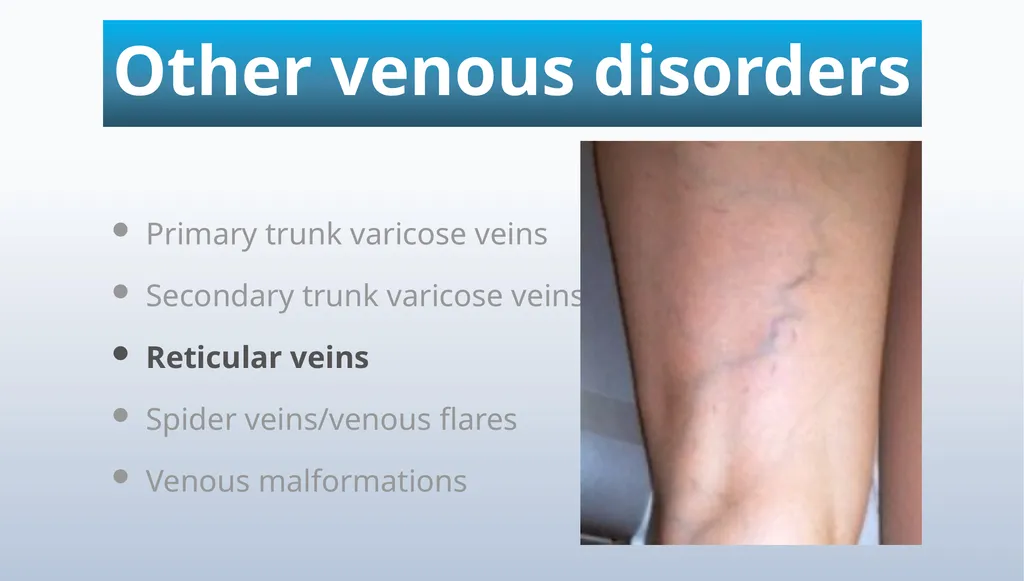 Varicose veins Miss Julie Reid Consultant Vascular - slide 7 of 33
