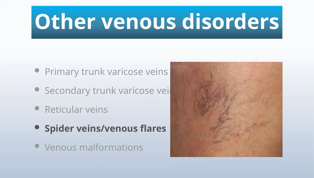 Varicose veins Miss Julie Reid Consultant Vascular - slide 8 of 33