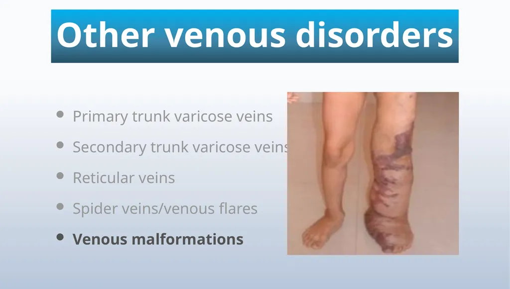 Varicose veins Miss Julie Reid Consultant Vascular - slide 9 of 33