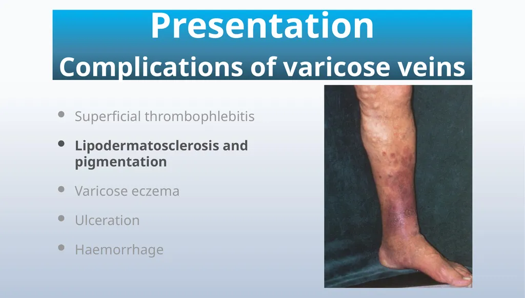 Varicose veins Miss Julie Reid Consultant Vascular - slide 13 of 33