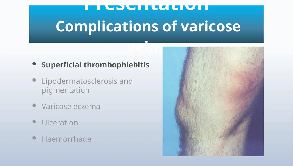 Varicose veins Miss Julie Reid Consultant Vascular - slide 12 of 33