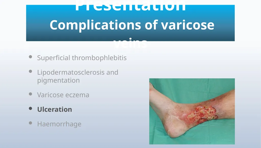 Varicose veins Miss Julie Reid Consultant Vascular - slide 15 of 33