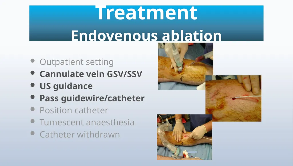 Varicose veins Miss Julie Reid Consultant Vascular - slide 28 of 33