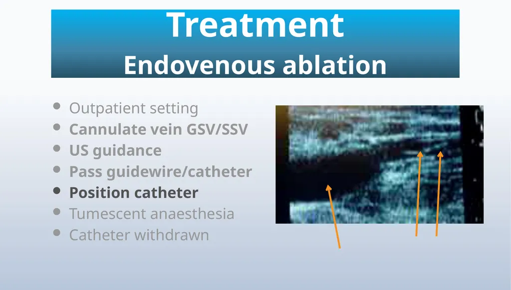 Varicose veins Miss Julie Reid Consultant Vascular - slide 29 of 33