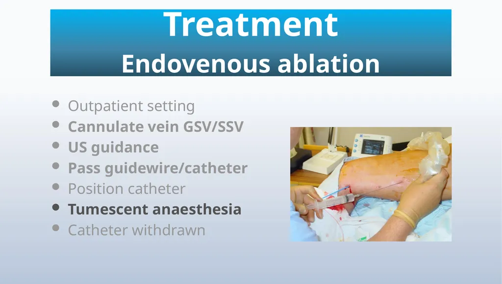 Varicose veins Miss Julie Reid Consultant Vascular - slide 30 of 33