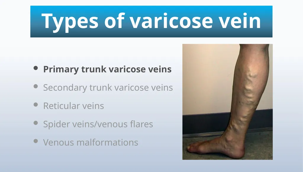 Varicose veins Miss Julie Reid Consultant Vascular - slide 5 of 33