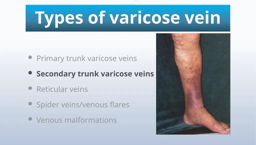 Varicose veins Miss Julie Reid Consultant Vascular - slide 6 of 33