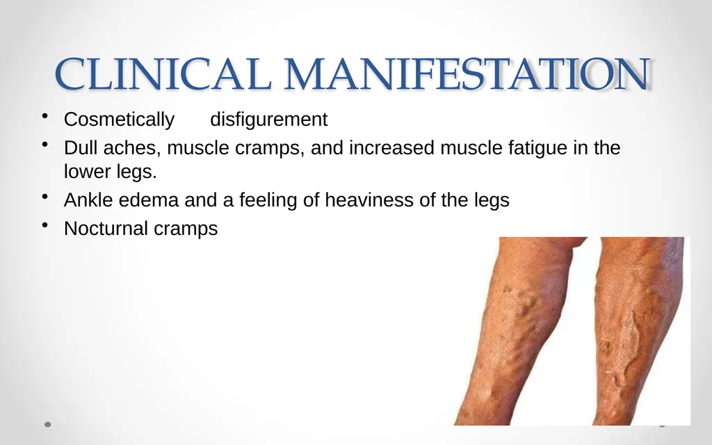 VARICOSE VEIN Odessa National Medical University - slide 11 of 19