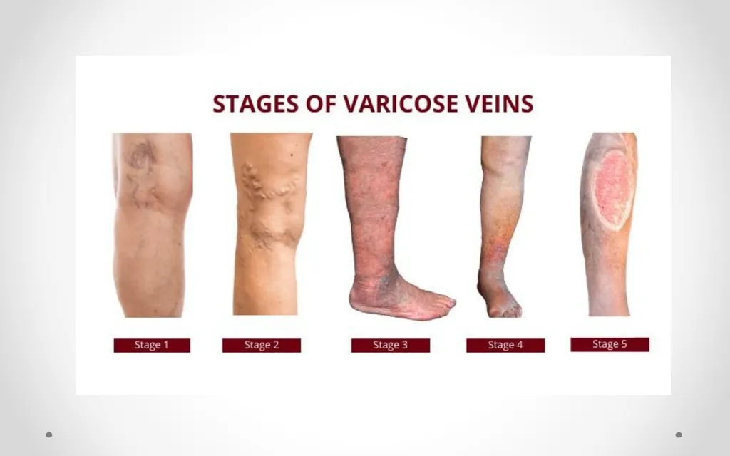 VARICOSE VEIN Odessa National Medical University - slide 2 of 19