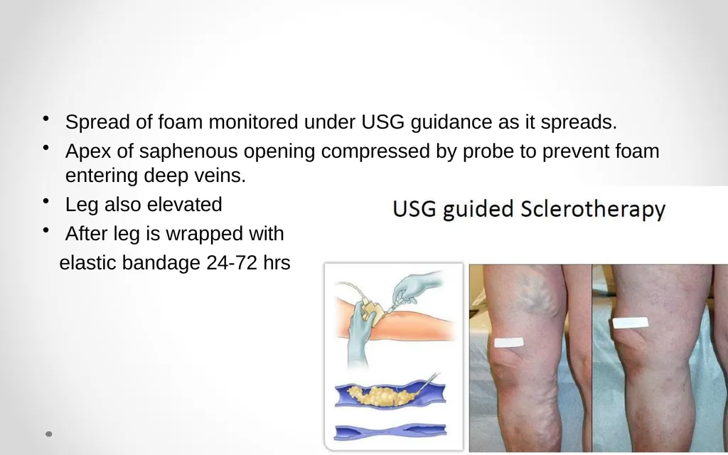 VARICOSE VEIN Odessa National Medical University - slide 16 of 19
