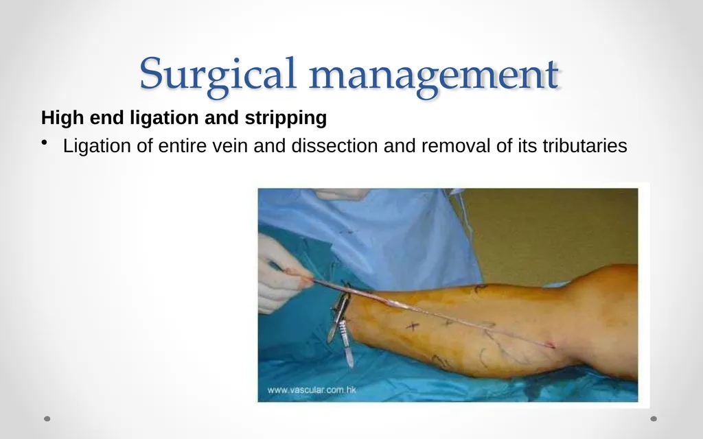VARICOSE VEIN Odessa National Medical University - slide 17 of 19