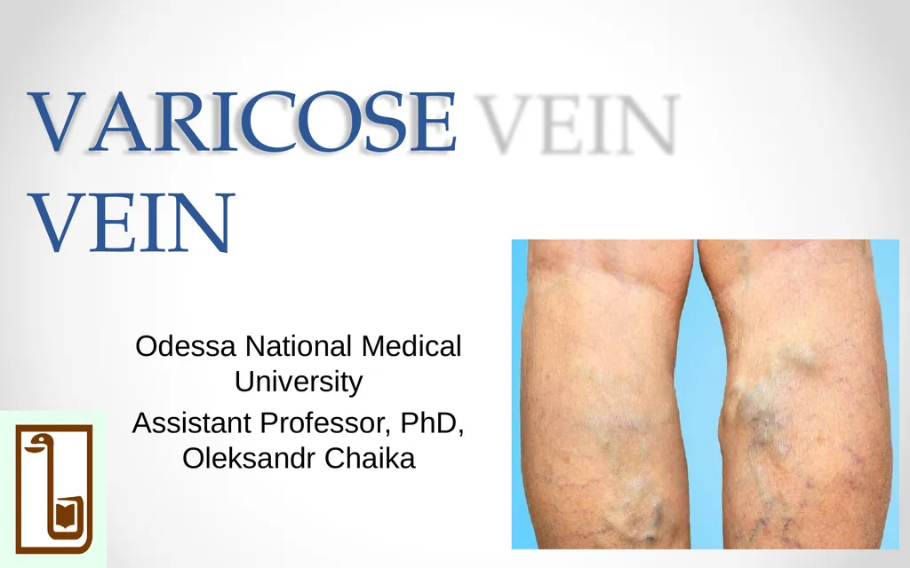 VARICOSE VEIN Odessa National Medical University - slide 1 of 19