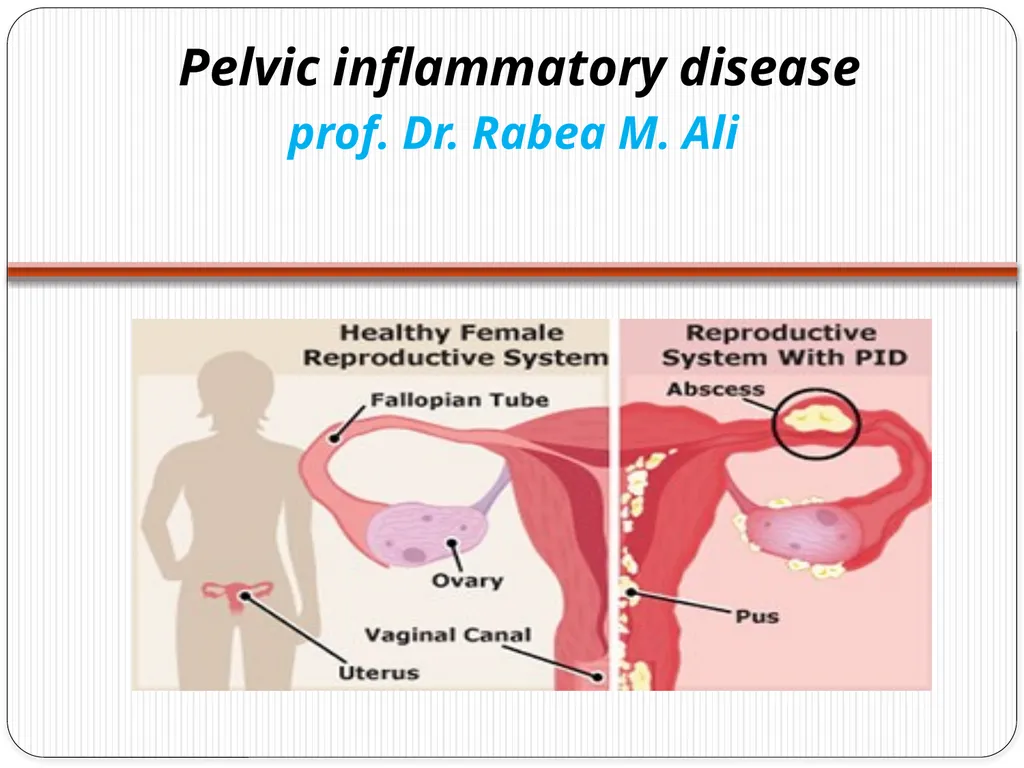 Pelvic inflammatory disease prof. Dr. Rabea M. Ali - slide 1 of 44
