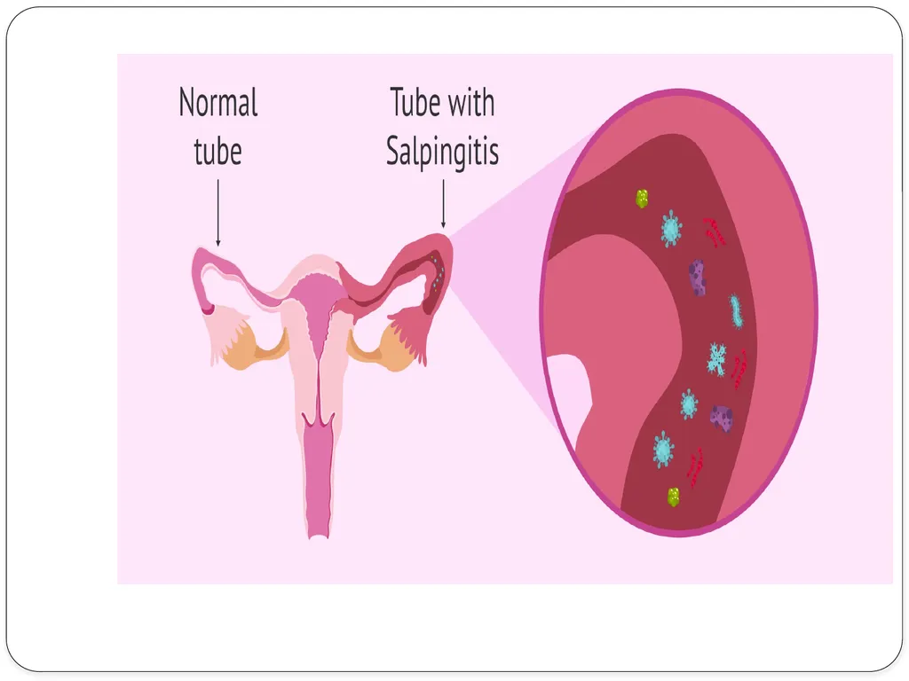 Pelvic inflammatory disease prof. Dr. Rabea M. Ali - slide 11 of 44