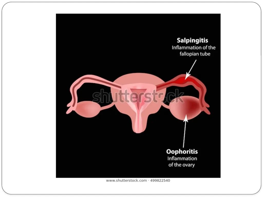 Pelvic inflammatory disease prof. Dr. Rabea M. Ali - slide 14 of 44