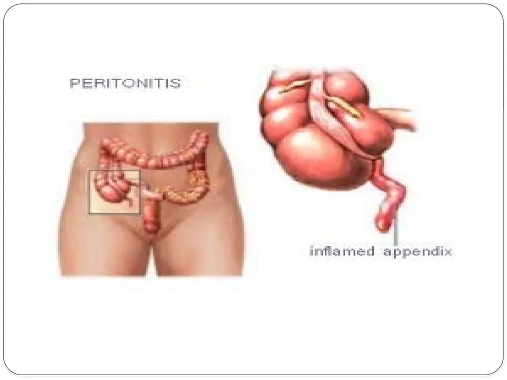 Pelvic inflammatory disease prof. Dr. Rabea M. Ali - slide 15 of 44