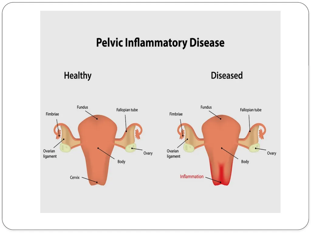 Pelvic inflammatory disease prof. Dr. Rabea M. Ali - slide 16 of 44