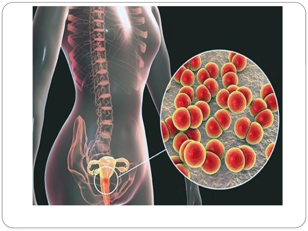 Pelvic inflammatory disease prof. Dr. Rabea M. Ali - slide 17 of 44
