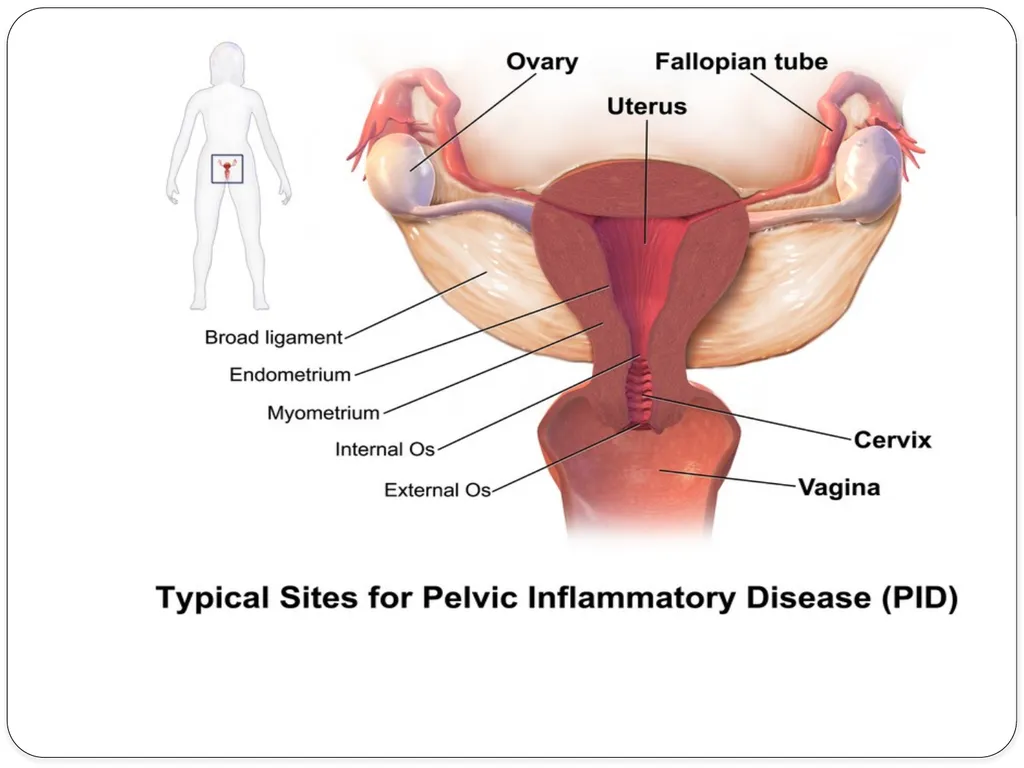 Pelvic inflammatory disease prof. Dr. Rabea M. Ali - slide 19 of 44